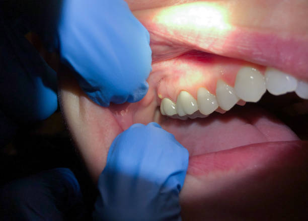 Best Emergency Dental Extractions in Laurinburg, NC